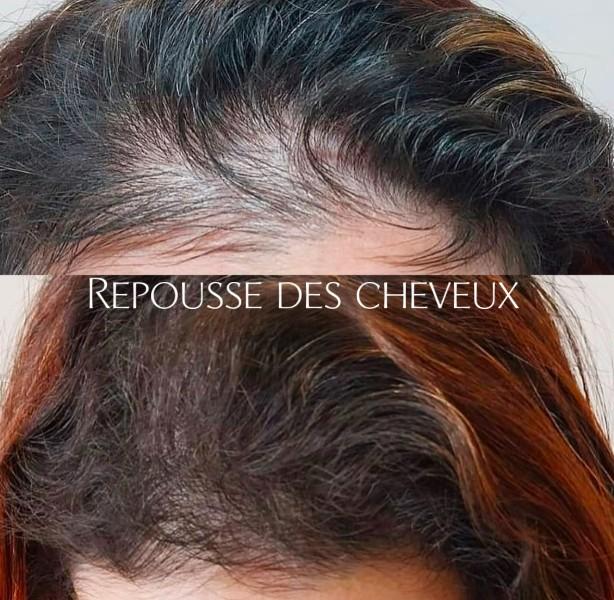 restructuration pilaire